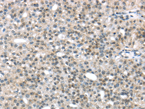 Immunohistochemistry of paraffin-embedded Human breast cancer tissue using TRIP6 Polyclonal Antibody at dilution 1:45