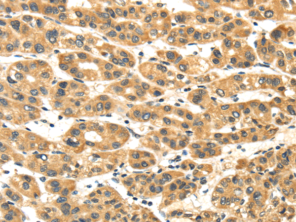 Immunohistochemistry of paraffin-embedded Human liver cancer tissue using NME8 Polyclonal Antibody at dilution 1:45