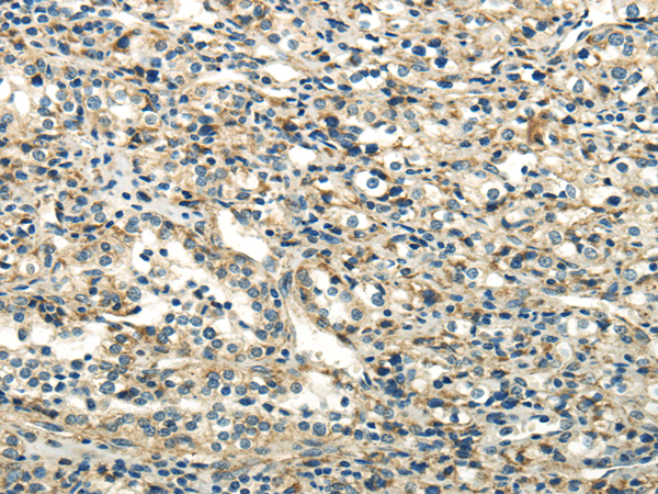 Immunohistochemistry of paraffin-embedded Human prostate cancer using DLAT Polyclonal Antibody at dilution of  1/40