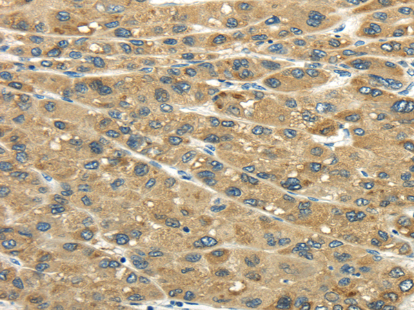 Immunohistochemistry of paraffin-embedded Human liver cancer tissue using UGT2B4 Polyclonal Antibody at dilution 1:45