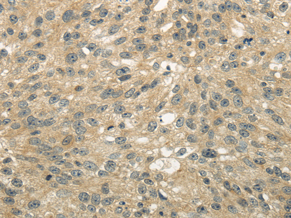 Immunohistochemistry of paraffin-embedded Human breast cancer tissue using UGT2B4 Polyclonal Antibody at dilution 1:45