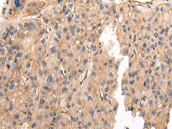 Immunohistochemistry of paraffin-embedded Human liver cancer using VAMP5 Polyclonal Antibody at dilution of  1/25