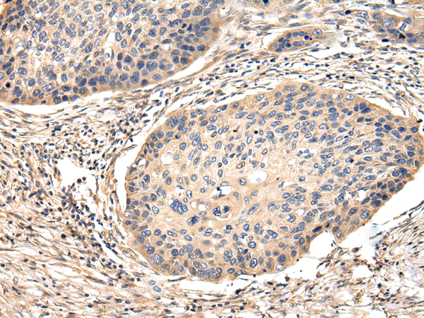 Immunohistochemistry of paraffin-embedded Human esophagus cancer tissue using VCAM1 Polyclonal Antibody at dilution 1:30