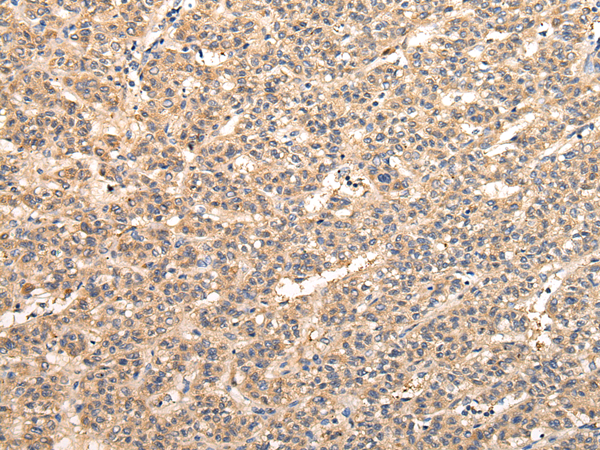 Immunohistochemistry of paraffin-embedded Human liver cancer tissue using VPS33B Polyclonal Antibody at dilution 1:40