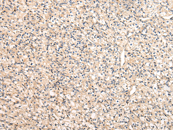 Immunohistochemistry of paraffin-embedded Human prostate cancer tissue using VPS33B Polyclonal Antibody at dilution 1:40