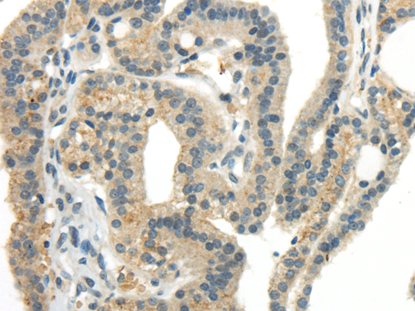 Immunohistochemistry of paraffin-embedded Human thyroid cancer tissue using CCL13 Polyclonal Antibody at dilution 1:40