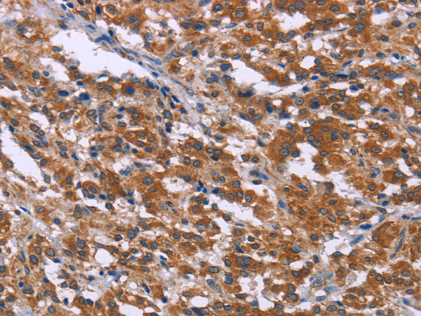 Immunohistochemistry of paraffin-embedded Human thyroid cancer tissue using SKI Polyclonal Antibody at dilution 1:40