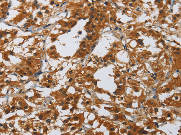 Immunohistochemistry of paraffin-embedded Human thyroid cancer tissue using MIP Polyclonal Antibody at dilution 1:40