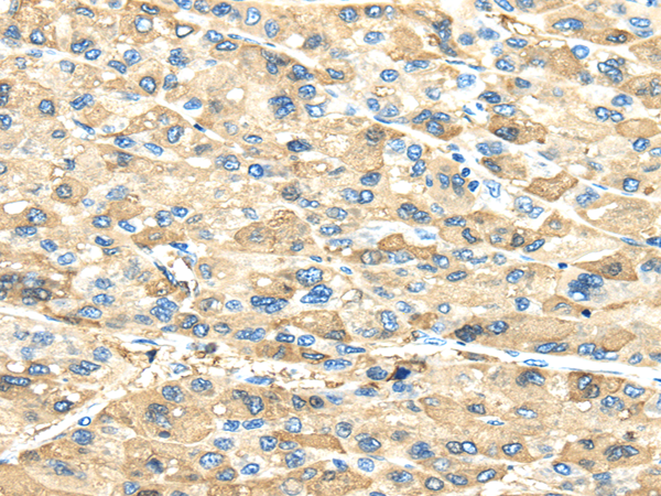 Immunohistochemistry of paraffin-embedded Human liver cancer using INHBB Polyclonal Antibody at dilution of  1/40