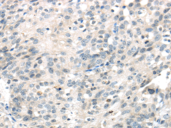 Immunohistochemistry of paraffin-embedded Human ovarian cancer using IQGAP2 Polyclonal Antibody at dilution of  1/40