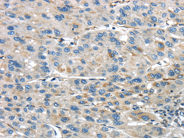 Immunohistochemistry of paraffin-embedded Human liver cancer using IQGAP2 Polyclonal Antibody at dilution of  1/45