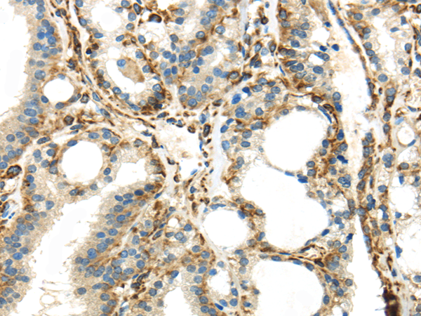 Immunohistochemistry of paraffin-embedded Human thyroid cancer using IQGAP2 Polyclonal Antibody at dilution of  1/45