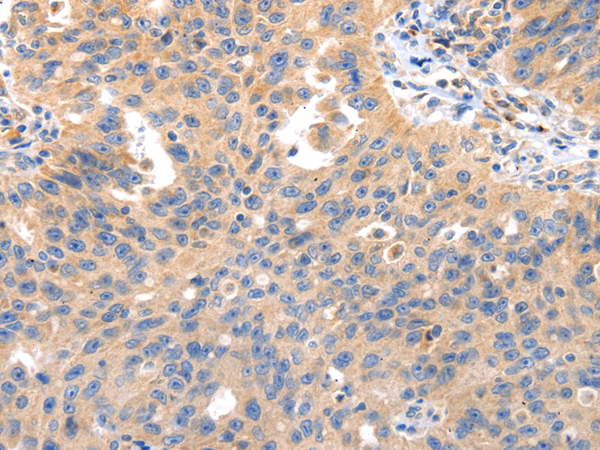 Immunohistochemistry of paraffin-embedded Human ovarian cancer tissue using IRS2 Polyclonal Antibody at dilution 1:50