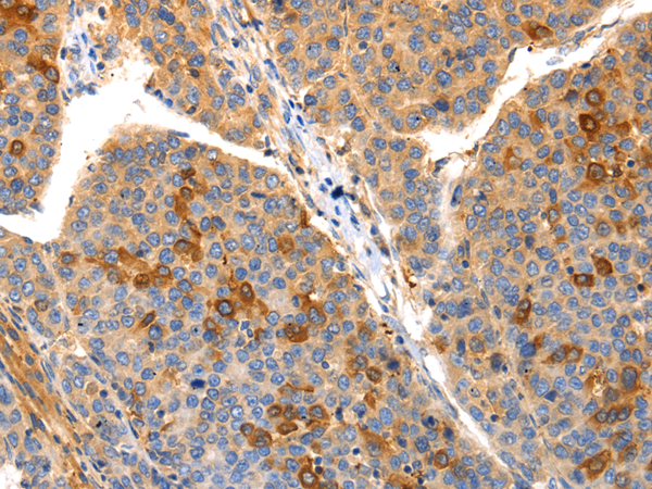 Immunohistochemistry of paraffin-embedded Human liver cancer tissue using IRS2 Polyclonal Antibody at dilution 1:50