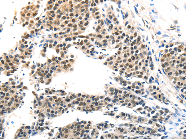 Immunohistochemistry of paraffin-embedded Human liver cancer tissue using MAGEA6 Polyclonal Antibody at dilution 1:120