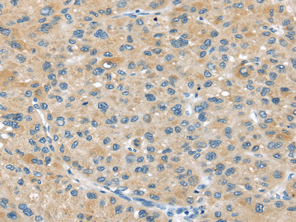 Immunohistochemistry of paraffin-embedded Human liver cancer tissue using ABCC2 Polyclonal Antibody at dilution 1:45