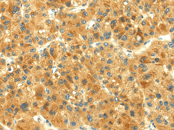 Immunohistochemistry of paraffin-embedded Human liver cancer using THAP3 Polyclonal Antibody at dilution of  1/30