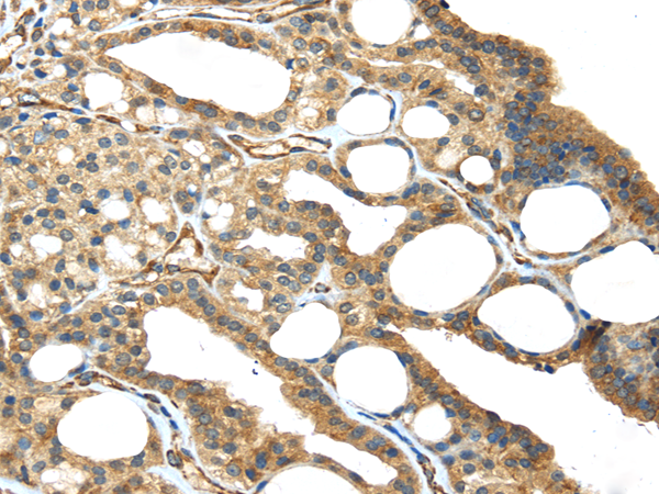 Immunohistochemistry of paraffin-embedded Human thyroid cancer using ISM2 Polyclonal Antibody at dilution of  1/45