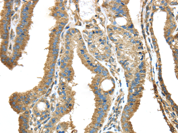 Immunohistochemistry of paraffin-embedded Human thyroid cancer using NME2 Polyclonal Antibody at dilution of  1/40