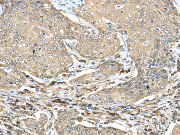 Immunohistochemistry of paraffin-embedded Human cervical cancer using NME2 Polyclonal Antibody at dilution of  1/40