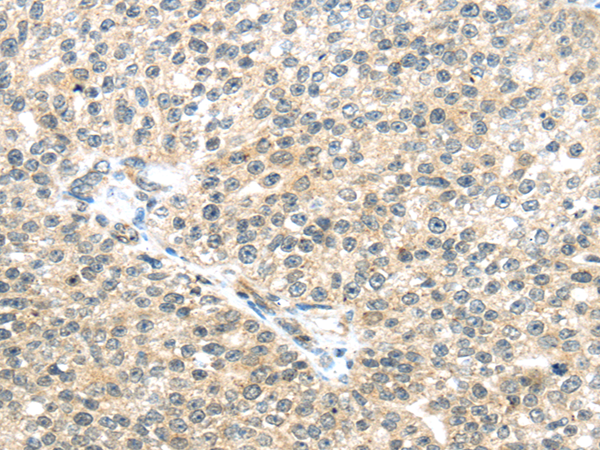 Immunohistochemistry of paraffin-embedded Human breast cancer tissue using TTBK2 Polyclonal Antibody at dilution 1:45