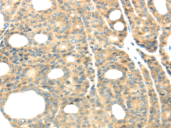 Immunohistochemistry of paraffin-embedded Human thyroid cancer tissue using TTBK2 Polyclonal Antibody at dilution 1:40