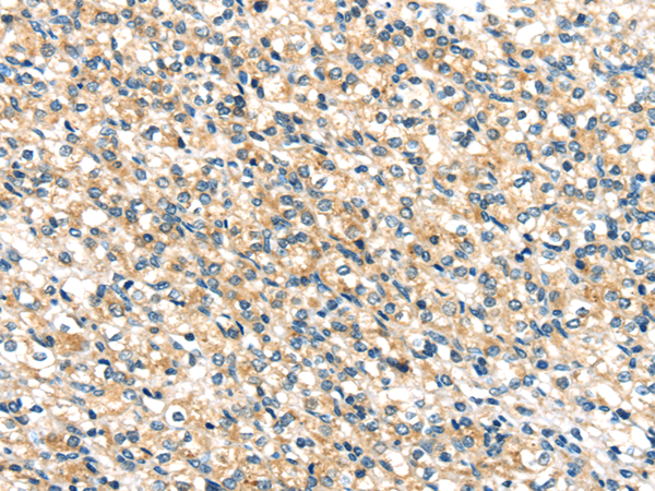 Immunohistochemistry of paraffin-embedded Human prostate cancer tissue using TTI1 Polyclonal Antibody at dilution 1:40