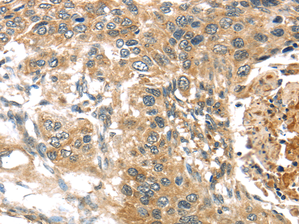 Immunohistochemistry of paraffin-embedded Human esophagus cancer tissue using TTI1 Polyclonal Antibody at dilution 1:40