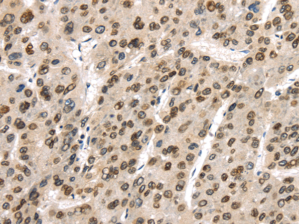 Immunohistochemistry of paraffin-embedded Human liver cancer using TUSC5 Polyclonal Antibody at dilution of  1/40