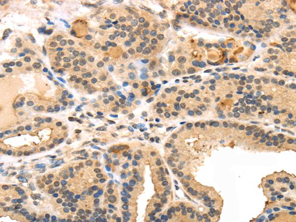 Immunohistochemistry of paraffin-embedded Human thyroid cancer using TUSC5 Polyclonal Antibody at dilution of  1/40