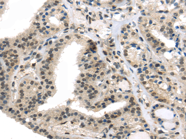 Immunohistochemistry of paraffin-embedded Human thyroid cancer tissue using TUSC5 Polyclonal Antibody at dilution 1:50