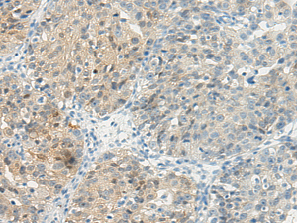 Immunohistochemistry of paraffin-embedded Human breast cancer tissue using TBXA2R Polyclonal Antibody at dilution 1:45