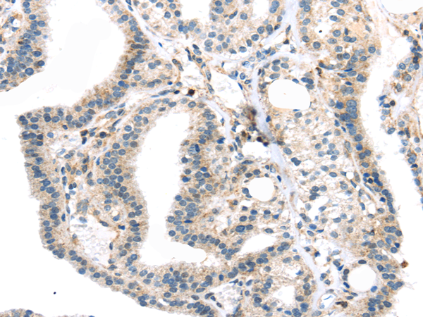 Immunohistochemistry of paraffin-embedded Human thyroid cancer using TBXA2R Polyclonal Antibody at dilution of  1/40