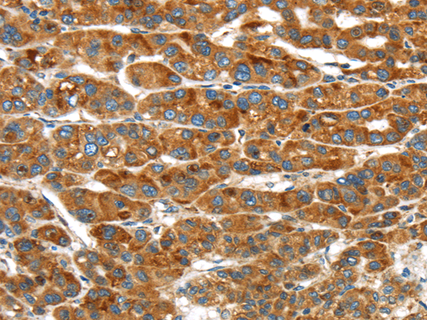 Immunohistochemistry of paraffin-embedded Human liver cancer using ERP44 Polyclonal Antibody at dilution of  1/20