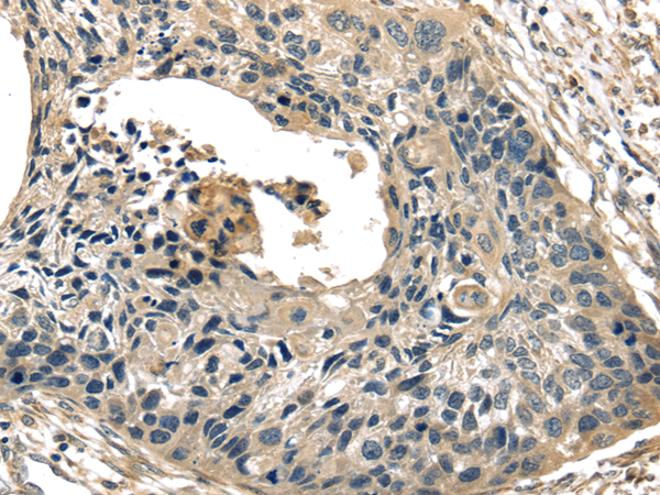Immunohistochemistry of paraffin-embedded Human esophagus cancer tissue using TXNIP Polyclonal Antibody at dilution 1:40