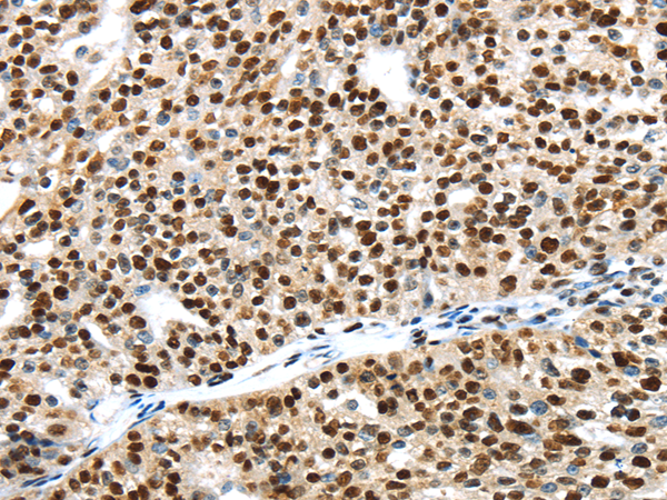 Immunohistochemistry of paraffin-embedded Human breast cancer using UBA1 Polyclonal Antibody at dilution of  1/40