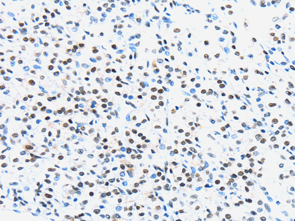 Immunohistochemistry of paraffin-embedded Human prostate cancer using UBA1 Polyclonal Antibody at dilution of  1/40