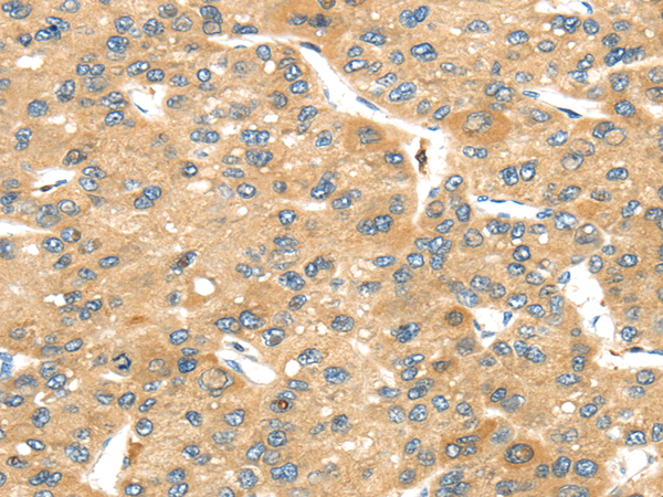 Immunohistochemistry of paraffin-embedded Human liver cancer tissue using UBTD2 Polyclonal Antibody at dilution 1:40