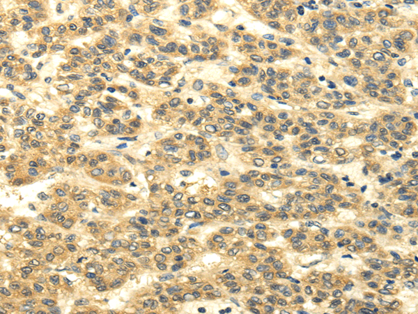 Immunohistochemistry of paraffin-embedded Human liver cancer using MSI1 Polyclonal Antibody at dilution of  1/35