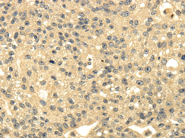 Immunohistochemistry of paraffin-embedded Human breast cancer using MSI1 Polyclonal Antibody at dilution of  1/35