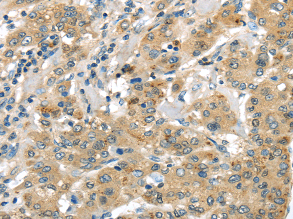 Immunohistochemistry of paraffin-embedded Human liver cancer using UTS2B Polyclonal Antibody at dilution of  1/35