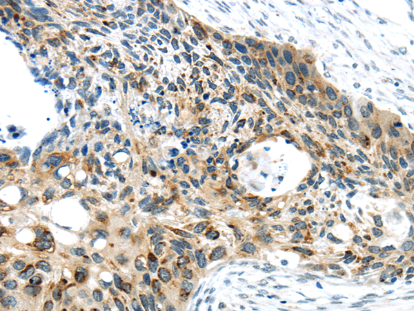 Immunohistochemistry of paraffin-embedded Human esophagus cancer using VAMP2 Polyclonal Antibody at dilution of  1/40