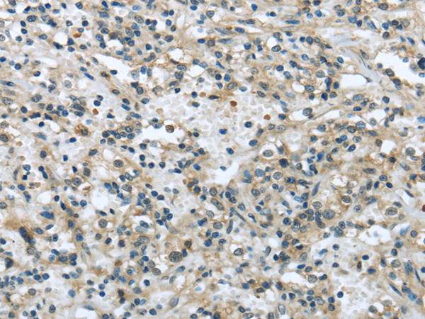 Immunohistochemistry of paraffin-embedded Human prostate cancer tissue using VPS4A Polyclonal Antibody at dilution 1:40