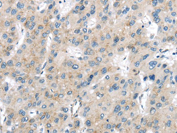 Immunohistochemistry of paraffin-embedded Human liver cancer using VPS26A Polyclonal Antibody at dilution of  1/40