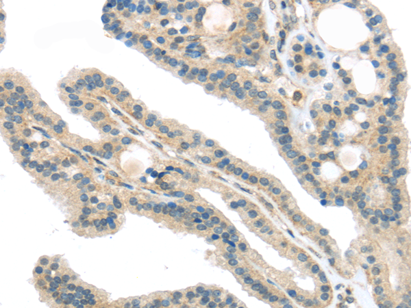 Immunohistochemistry of paraffin-embedded Human thyroid cancer using VPS26A Polyclonal Antibody at dilution of  1/40