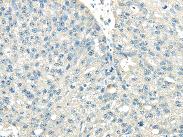 Immunohistochemistry of paraffin-embedded Human breast cancer tissue using VPS36 Polyclonal Antibody at dilution 1:40