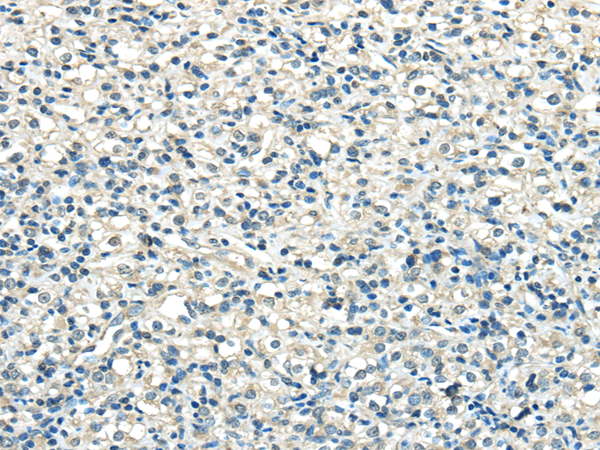 Immunohistochemistry of paraffin-embedded Human prostate cancer tissue using VPS36 Polyclonal Antibody at dilution 1:40