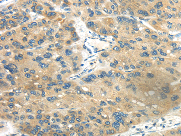 Immunohistochemistry of paraffin-embedded Human liver cancer tissue using CD70  Polyclonal Antibody at dilution 1:40