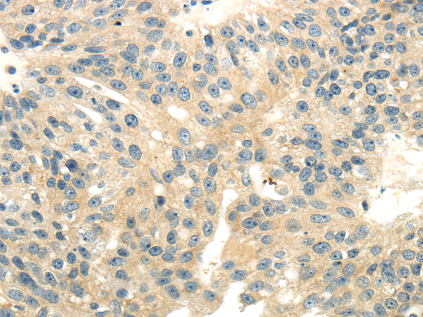 Immunohistochemistry of paraffin-embedded Human breast cancer tissue using CD70  Polyclonal Antibody at dilution 1:40