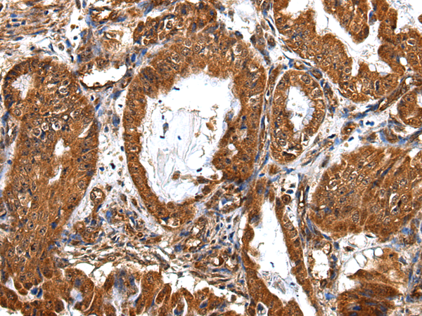 Immunohistochemistry of paraffin-embedded Human esophagus cancer tissue using ZBTB2 Polyclonal Antibody at dilution 1:40